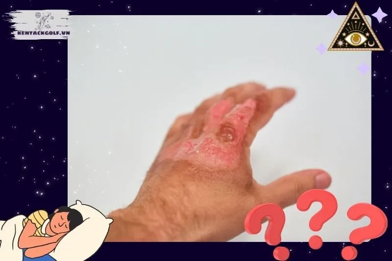 Giải mã giấc mơ bị bỏng – Ý nghĩa và điềm báo chính